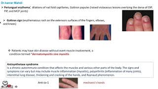 19 Polymyositis and Dermatomyositis [upl. by Pelson791]