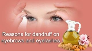 Reasons for dandruff on eyebrows and eyelashes  Onlymyhealthcom [upl. by Hnahk]