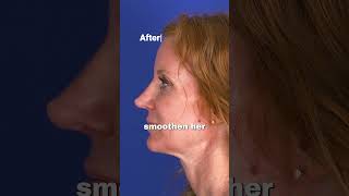 Revision Rhinoplasty Case rhinoplastyrevision revisionsurgery facialplasticsurgery [upl. by Annaliese819]