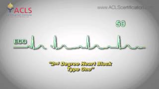 Second Degree Heart Block Type One by ACLS Certification Institute [upl. by Vachil762]