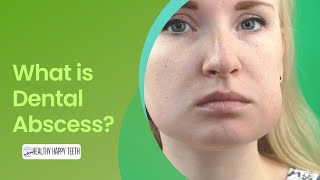 What is a Dental Abscess What are The Symptoms and How is it Treated [upl. by Anelahs83]