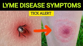 Early Signs of Lyme Disease What to Watch For [upl. by Karney]