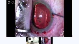 Live ICL Surgery  Dr Robert Rivera from Hoopes Visionmp4 [upl. by Ewnihc952]