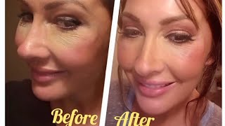 TCA peel for thin crinkly undereyes [upl. by Georglana]