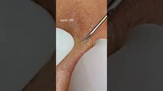 Pickel Ausdrücken Spa  Blackheads Akne amp Mitesser entfernen 🔴 11 [upl. by Illene]