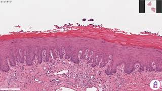 Moderate Epithelial Dysplasia [upl. by Carolina]