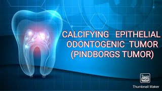 CALCIFYING EPITHELIAL ODONTOGENIC TUMOR PINDBORGS TUMOR [upl. by Garland681]