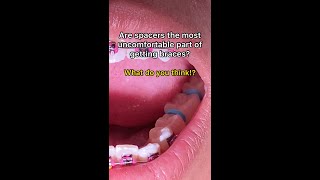 What Are Orthodontic Separators Spacers Tooth Time Family Dentistry New Braunfels Texas [upl. by Giorgia]