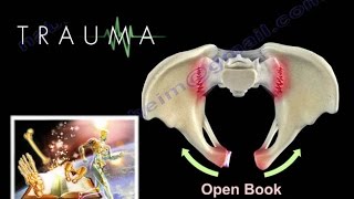 Damage Control Orthopaedics  Everything You Need To Know  Dr Nabil Ebraheim [upl. by Anima]