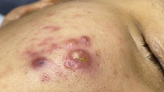 Satisfying With Loan Nguyen Spa Video 064 acnetreatment [upl. by Thadeus]