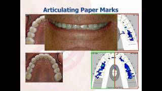 What is the TScan™ Computerized Occlusal Analysis System [upl. by Herta]