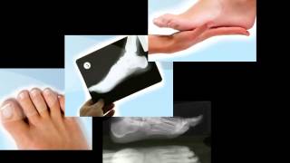 How to Tape a Hammer Toe [upl. by Aleda283]