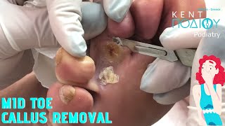 Mid toe callus removalΑφαίρεση μεσοδακτύλιου κάλουΚέντρο Ποδιού PodiatryPodiatristΠοδιατρική [upl. by Ynnam536]