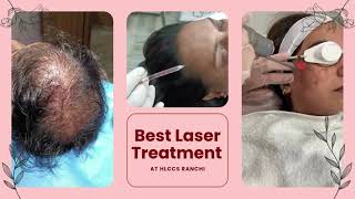 Best Laser treatment at HLCCS RANCHICall now 9334334935 laser skincare beauty laserhairremoval [upl. by Nanice]