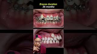 Como um aparelho funciona shorts braces dentist [upl. by Nada552]