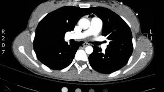 Chest Pneumomediastinum Axial CT JETem 2018 [upl. by Batchelor215]