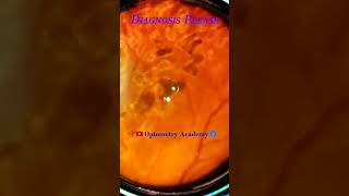 Smartphone Fundus Videography  Fundus Photography  Retinal Pathology  Short Video 50 [upl. by Olivia]