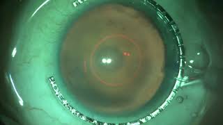 CAPSULASER Precision Trifocal [upl. by Ennairac993]