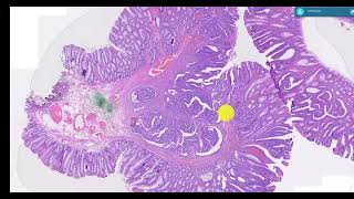 case 1 adenoma with misplaced epithelium colon [upl. by Weikert916]