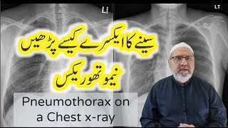 Pneumothorax on a Chest x ray  Chest xray interpretation in Urdu  Hindi [upl. by Monjo]