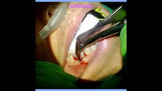 Simple Tooth Extraction using Cowhorn Forceps [upl. by Newel151]