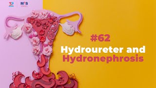 Hydroureter and Hydronephrosis [upl. by Bilat]