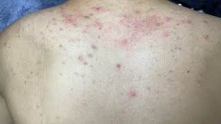 ACNE TREATMENT VU QUYNH MI  Acne On Back FULL [upl. by Amari374]