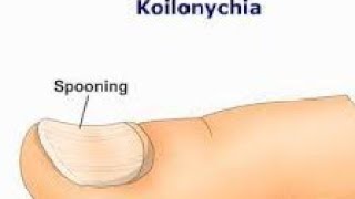 Koilonychia  Spoon nails  Spooning of nails Causes Diagnosis Symptoms Treatment [upl. by Deva]