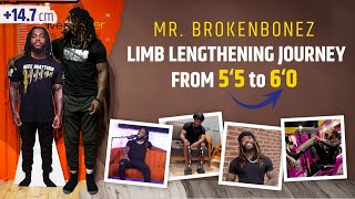 MR BROKENBONES LIMB LENGTHENING JOURNEY FROM 5‘5 TO 6‘0 [upl. by Akelam]