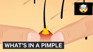 Whats Inside Of A Pimple [upl. by Dolores]