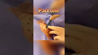 Cystic Acne Treatment  Cyst and Blackhead extraction  Pimple Popping  Clogged Pores 158 [upl. by Torbart460]