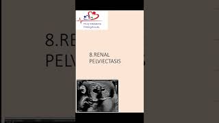 Renal pelviectasis on antenatal scanwhat should we do renalpelviectasis [upl. by Amiaj847]