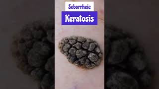 Seborrheic Keratosis overview [upl. by Anitnelav]