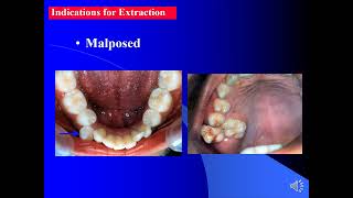 Exodontia 402oral surgery part1 [upl. by Rogerio]