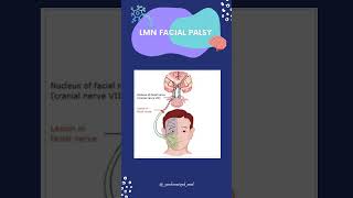 LMN Vs UMN FACIAL PALSY youtubeshorts neurology cranialnerves mbbs [upl. by Zampino]