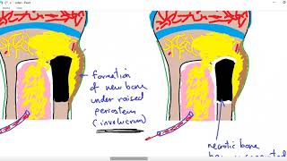 Systemic pathology 34  bone 4  osteomyelitis  DRSAMEH GHAZY [upl. by Kavanaugh]