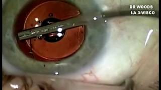 ECP laser for glaucoma during cataract surgery [upl. by Bosch]