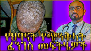 የህፃናት የጭንቅላት ፈንገስ መፍትሄዎች  Dr Fasil [upl. by Harden132]