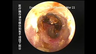 Ear canal cleaning operations under extremely narrow conditions 20240321 [upl. by Latisha120]