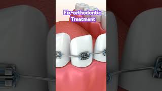 Braces treatment dentist trending teeth shortsvideo success foryou youtubeshorts dentist [upl. by Ilyssa]