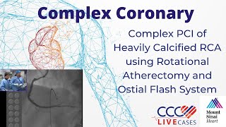 Complex PCI Heavily Calcified RCA using Rotational Atherectomy amp Ostial Flash System Oct 2014 Video [upl. by Assirehs]