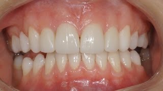 Виниры без обточки зубов Люминиры Veneers without teeth preparation Carillas Dentales 牙齿镶 [upl. by Revert]