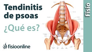 Tendinitis de psoas ilíaco o psoitis  Qué es causas síntomas y tratamiento [upl. by Paik]