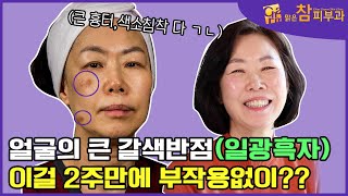 이게 가능하다고 얼굴에 있는 큰 검버섯흑자 완전 제거 [upl. by Irolam]