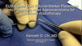 EUS guided Fiducial Marker Placement into Pancreatic head Adenocarcinoma for Cyberknife Radiotherapy [upl. by Knowles]