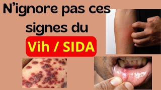 Quels sont les 13 signes du VIH  SIDA [upl. by Yhpos]