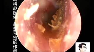 Earwax Removal Extractions Endoscopy Clean Chip Like Earwax Bothside 耳内镜清理干片两例 外耳道挖耳屎清理 耳 [upl. by Ul40]