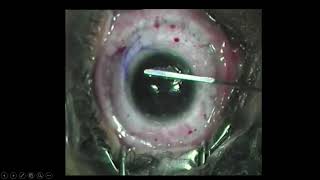 Post LASIK Ectasia  Tackling PostRefractive Surgery Challenges [upl. by Seldun]