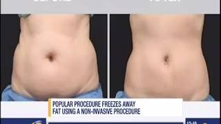 CoolSculpting Treatment on News 12 Connecticut with Before and Afters [upl. by Griggs]