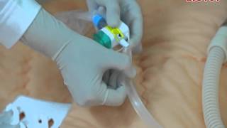 Pediatric Color Coded Y Closed Suction Catheter [upl. by Tyrrell]